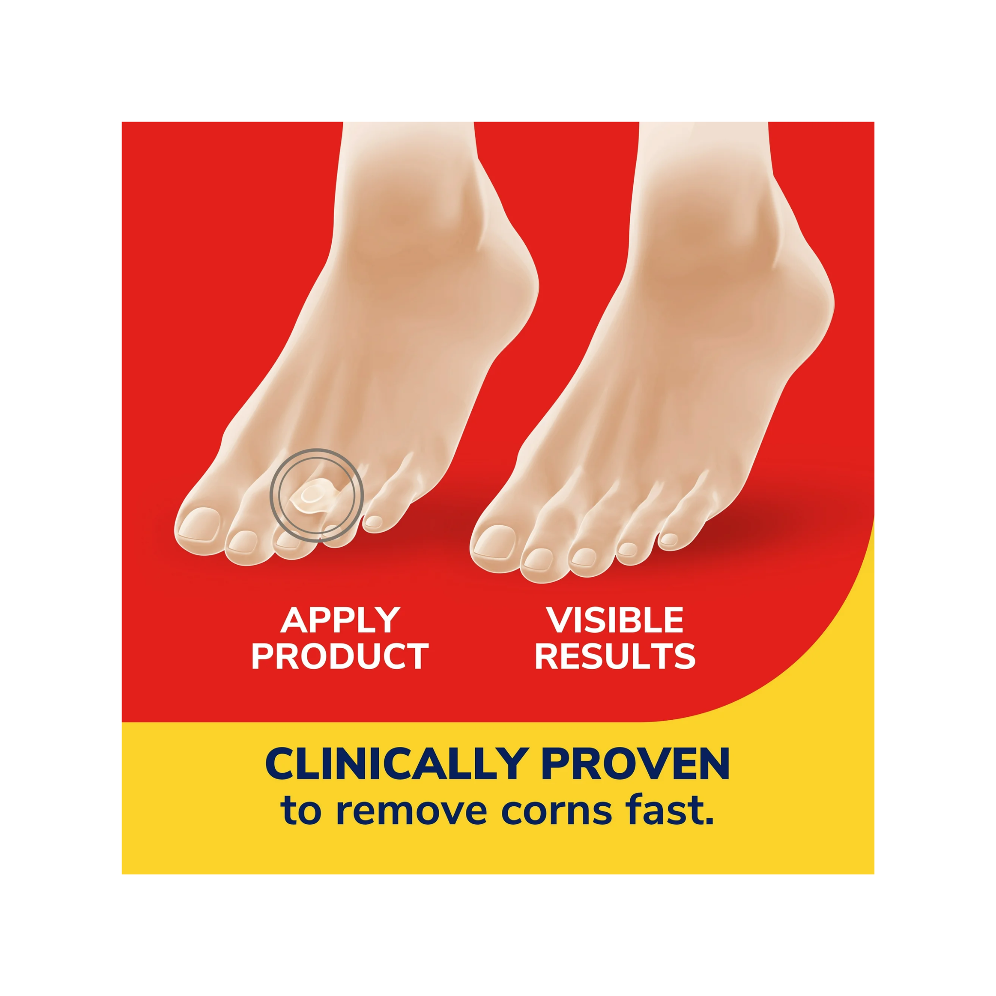 Dr. Scholl's, Corn Removers Seal & Heal Bandage, Hydrogel Technology for Corn Relief, 6 Count