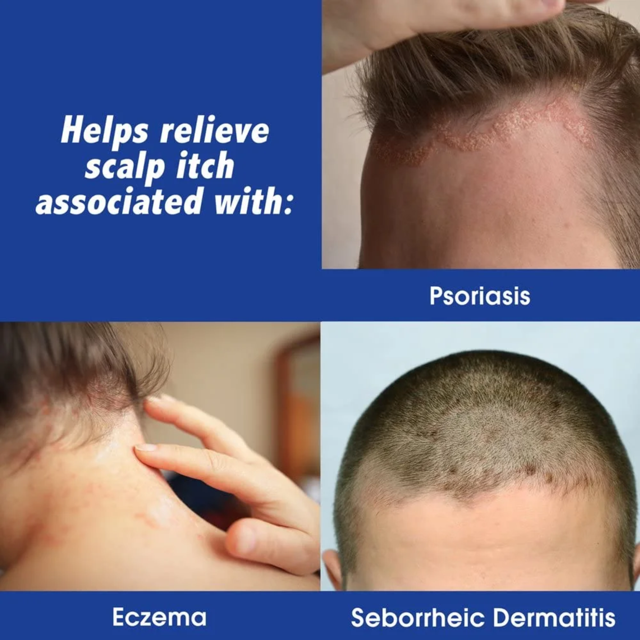 Scalpicin, Max Strength Scalp Itch Treatment, Fast-Acting Relief for Itchy Scalp, 1.5 oz